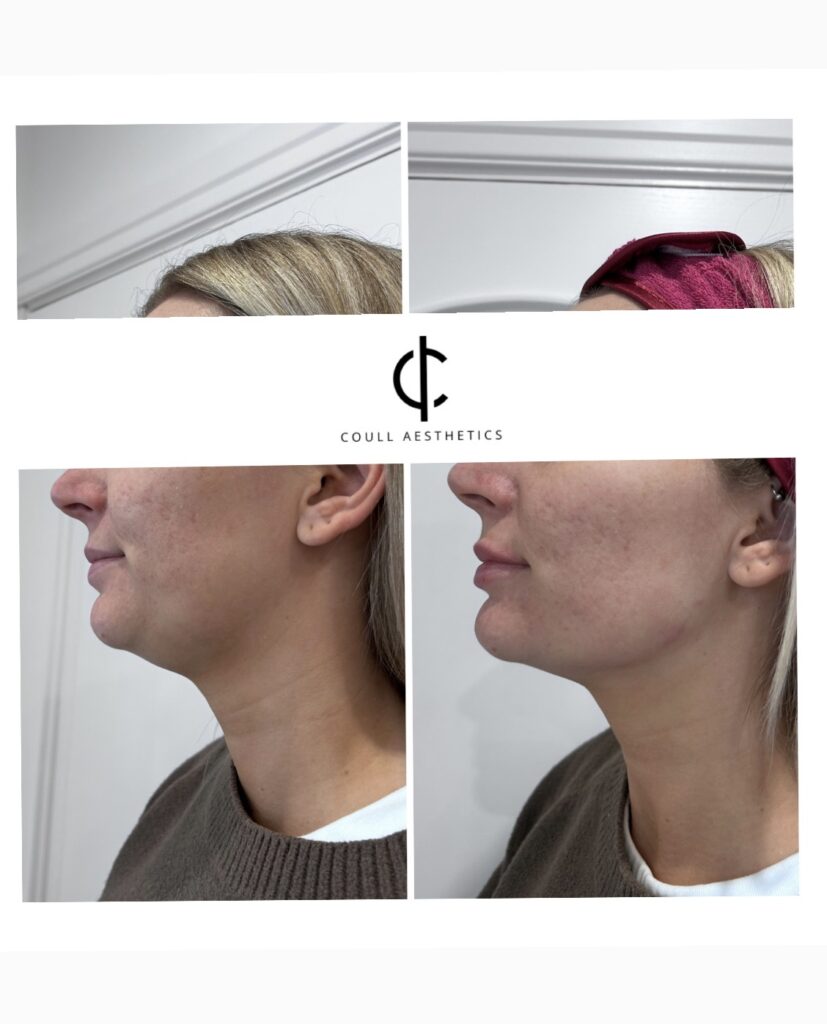 Client treatment photograph supplied for the dermal fillers page
