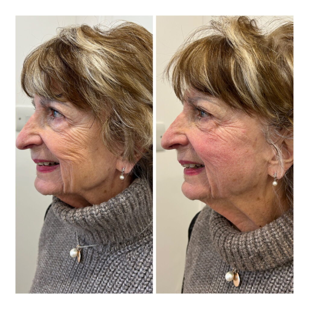 Sculptra before-and-after patient photograph