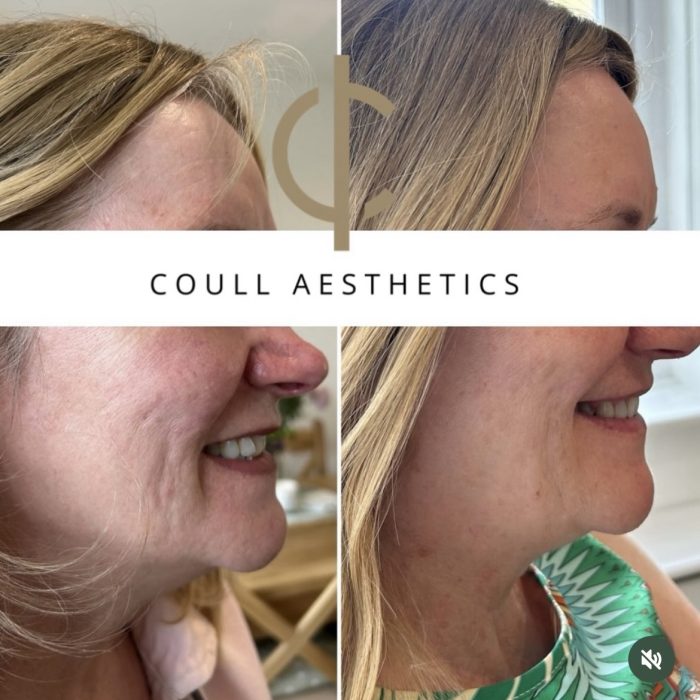 PROFHILO before and after 1 treatment